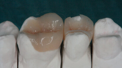 Riabilitazione diretta e indiretta mediante l’ausilio della stessa resina composita: case report