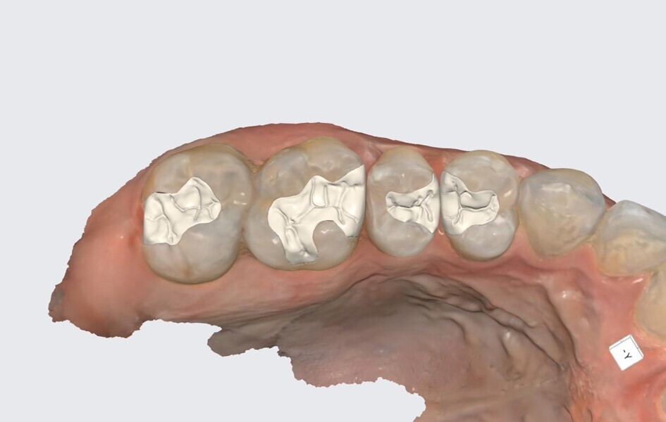 Fig. 23: Virtual design of the restorations in preparation for 3D printing.