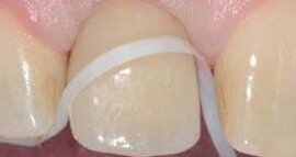 Właściwa higiena – faza podtrzymująca leczenia implantologicznego