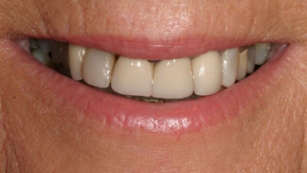 Intérêt des provisoires dans les cas de reconstructions complexes