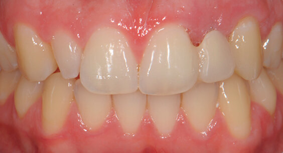 Fig. 2 - Foto inziali del caso. Si noti la presenza di elemento 12 di conformazione conoide e agenesia di elemento 22 sostituito con protesi tipo Maryland.