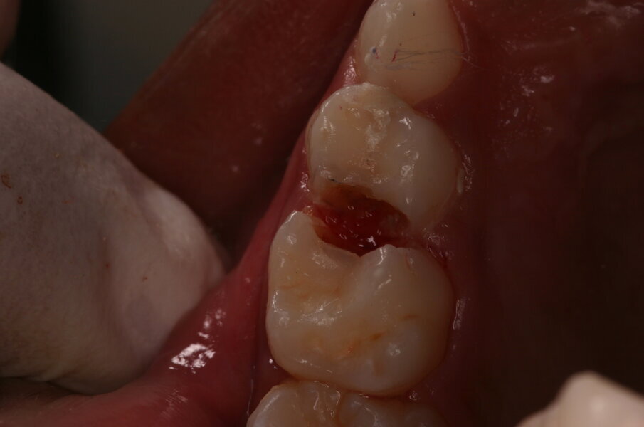 Afbeelding 5c. De kleine mesiale caviteit in de 64 is door middel van de ART-methode gerestaureerd. De andere twee caviteiten zijn nu toegankelijk voor tandenborstel en fluoridetandpasta.