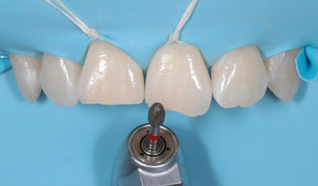 Fig. 6: Minimally invasive tooth preparation with a diamond bur.