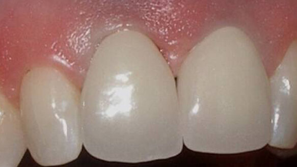 Zirconium dioxide implant solutions: A metal-free option