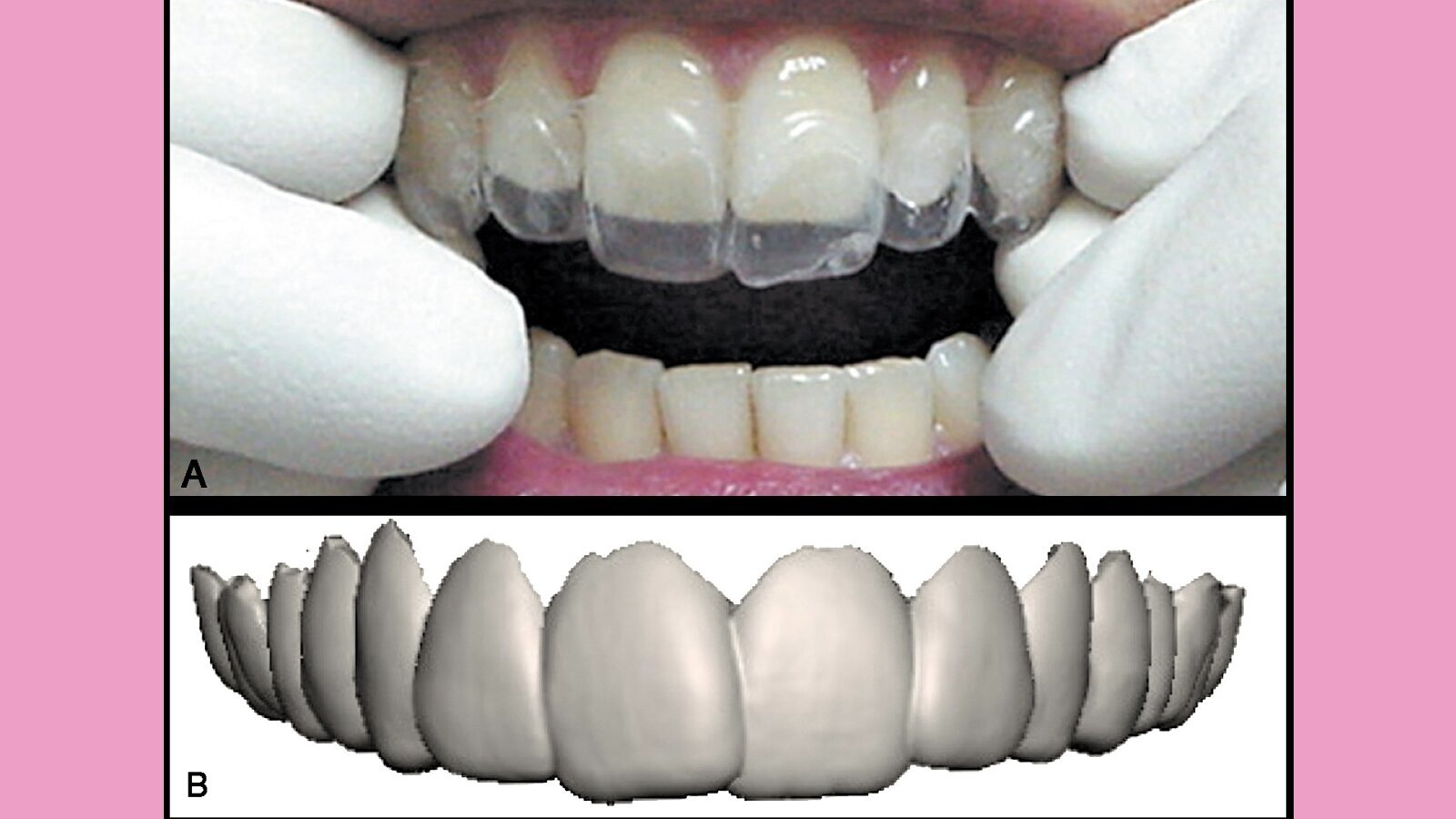 Estética y blanqueamiento dental en la era digital (Capítulo 4)