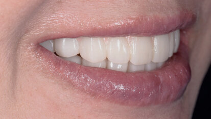 Customised aesthetics for provisional profile prosthesis with ceramage gum