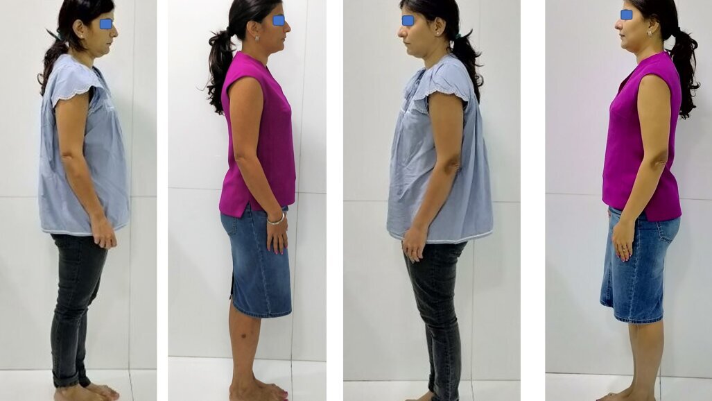 A Clinical Observation: Relation Between Dental Occlusion & Posture