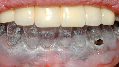 Protesi avvitata a medio lungo termine a carico immediato. Tecnica del “porta impronte dinamico”