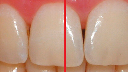 Valutazione clinica dell’azione sbiancante  di un dentifricio a base di biossido di titanio  con attivazione a luce led