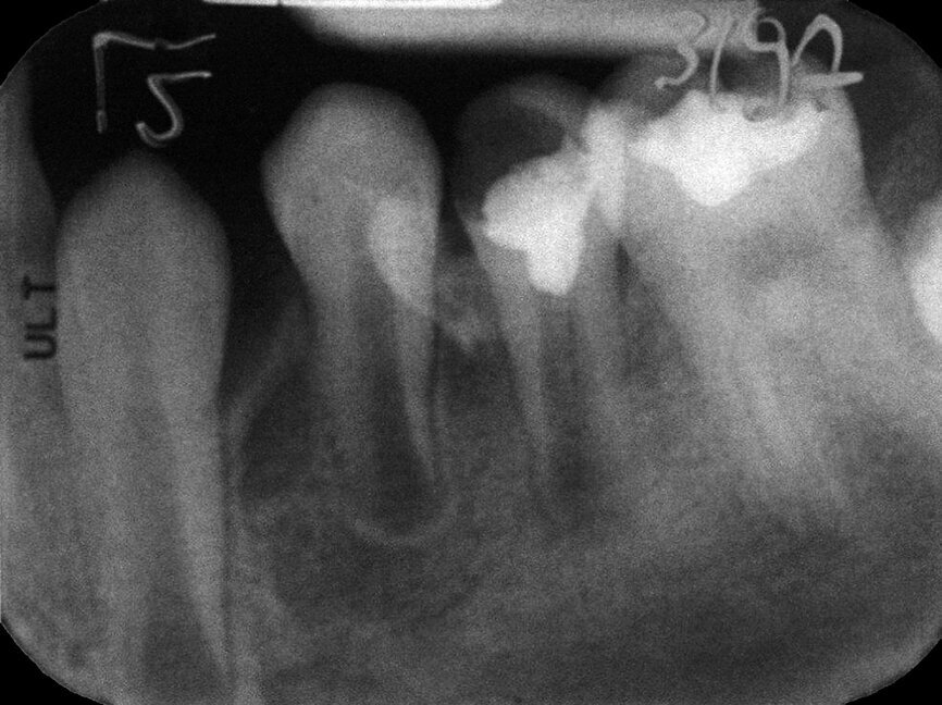 Case 1: Male (born 5 June 1987): Tooth 35
Fig. 3b: 18 March 1997 post pulpotomy