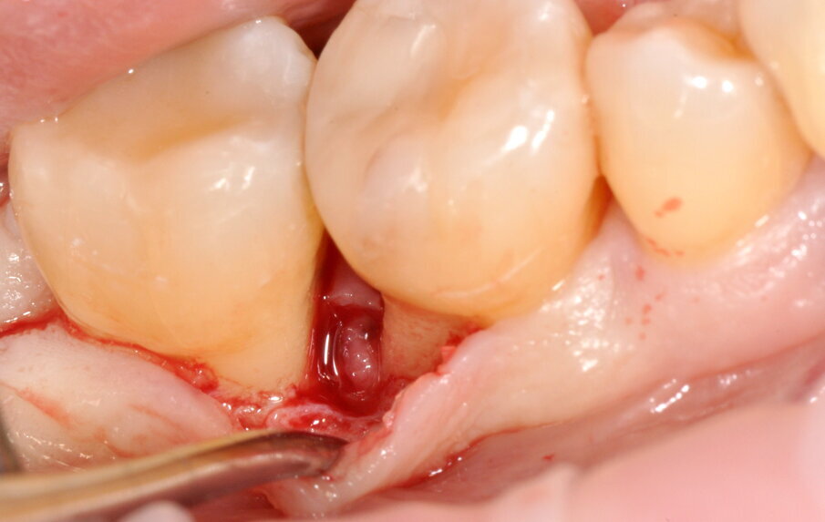 Fig. 8 - Scollamento del lembo a tutto spessore.
