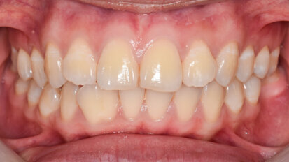 Researchers uncover how oral bacteria can affect the aggressiveness of colon cancers