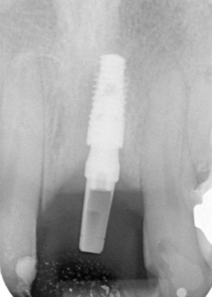 Fig. 2_Rx immediatamente dopo il posizionamento dell’impianto GTB e del Moncone Easy Slim. Notare la perfetta congruenza tra l’impianto e lo spazio di preparazione.