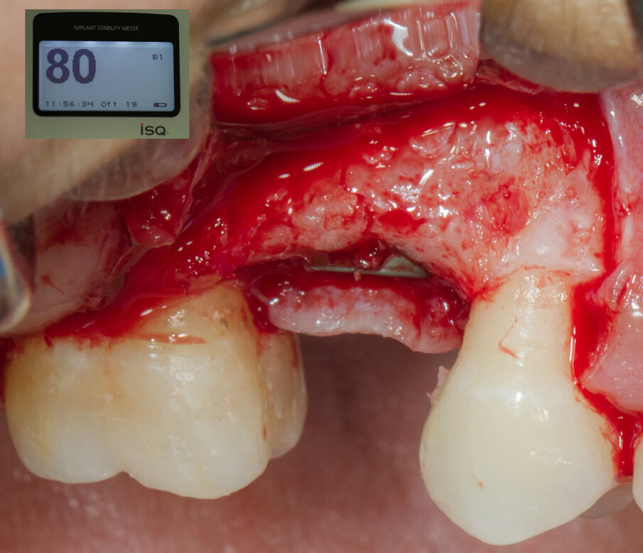 Fig. 23 - ISQ di inserimento dell’impianto - 80.