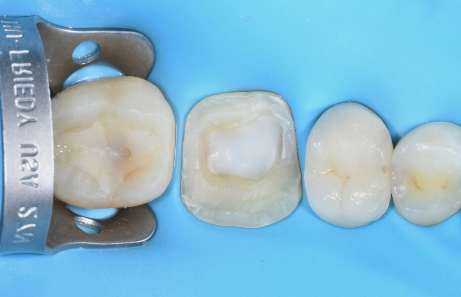 Fig. 7b: Endodontic treatment of tooth #46: application of a layer of flowable composite to the floor of the pulp chamber before luting of the endocrown.