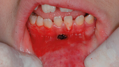 Vantaggi dell’utilizzo di un laser a Er:YAG: nella chirurgia pedodontica