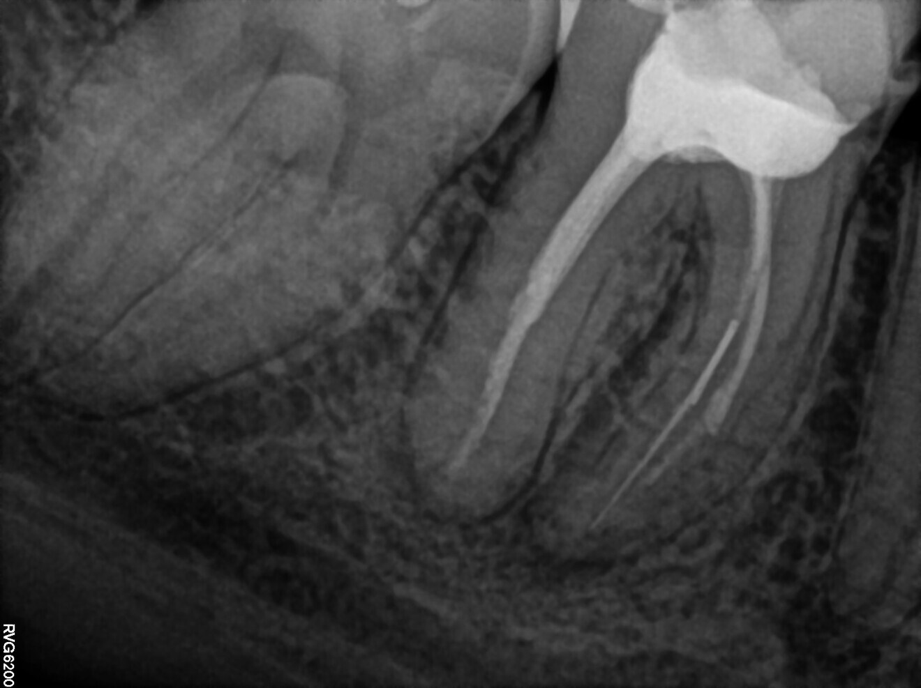 Fig. 13: Pre-op radiograph. Two pieces of the broken file visible.