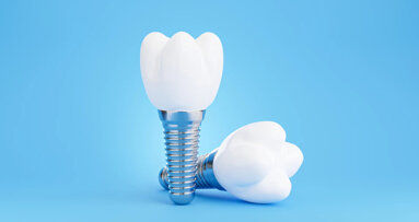 Impianti dentali fatti su misura grazie alla stampa 3D