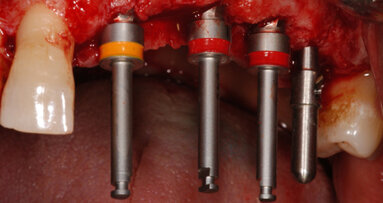 Riabilitazione di un caso complesso con impianti in zirconia