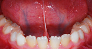 Analisi della variazione posturale cervicale prima e dopo la frenulotomia linguale laser