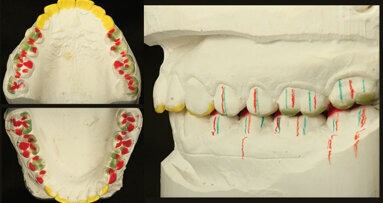 The gold standard: IPS e.max Press – one  material for virtually all indications?!