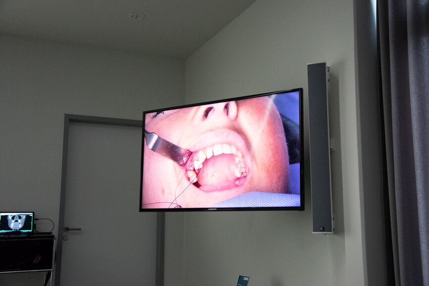 Während der Live-OP setzte Rothamel einer Patientin mit multiplen Nichtanlagen zwei Implantate.