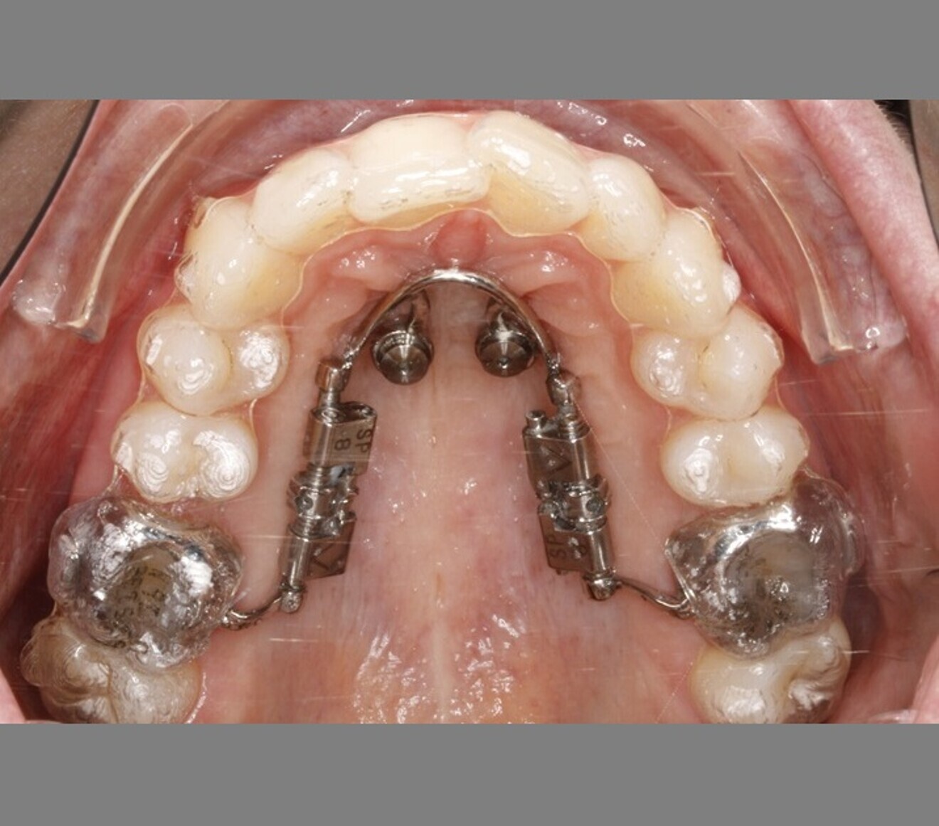 Fig. 6: Skeletally anchored distaliser used simultaneously with aligners. Greater distalisation was performed in the maxillary right quadrant than in the maxillary left quadrant.