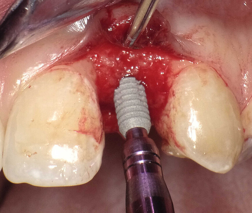 Fig. 5 : L’implant de Ø 3 mm est inséré dans le site élargi de l’ostéotomie. Il faut noter le design en plateau et l’épaulement incliné au niveau du col. 