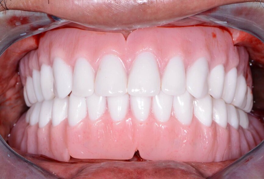 Fig. 19: Immediate post-op retracted view.