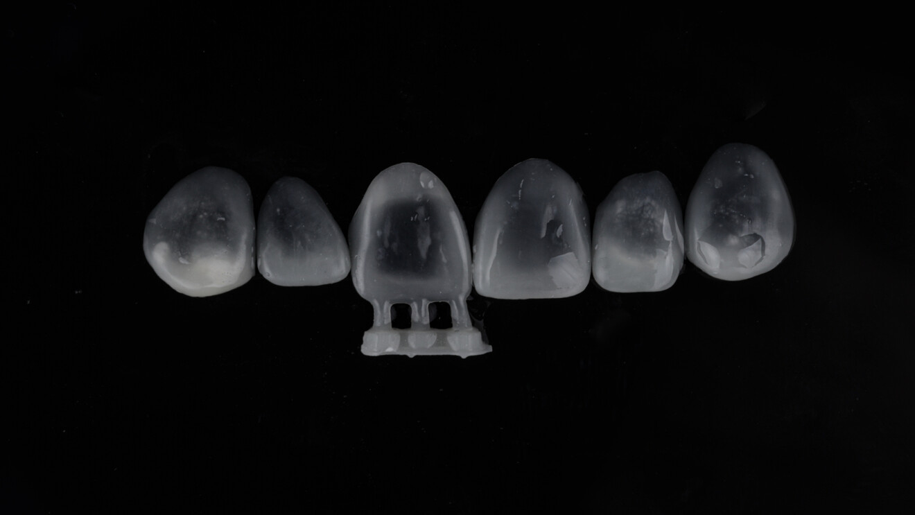Fig. 4e: Six maxillary anterior veneers before finishing and polishing.