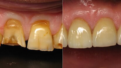 Tenet: Time inversion applied to dentistry