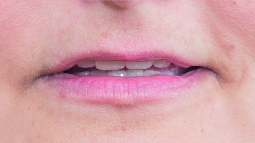 Fig. 11: Final appearance on lip rest position showing good amount of tooth structure.