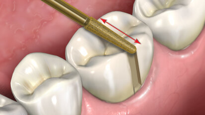 Fig. 4: A slot is next cut across the occlusal surface in a similar manner that is continuous with the slot cut on the buccal surface, again moving the diamond-coated bur parallel to its long axis.