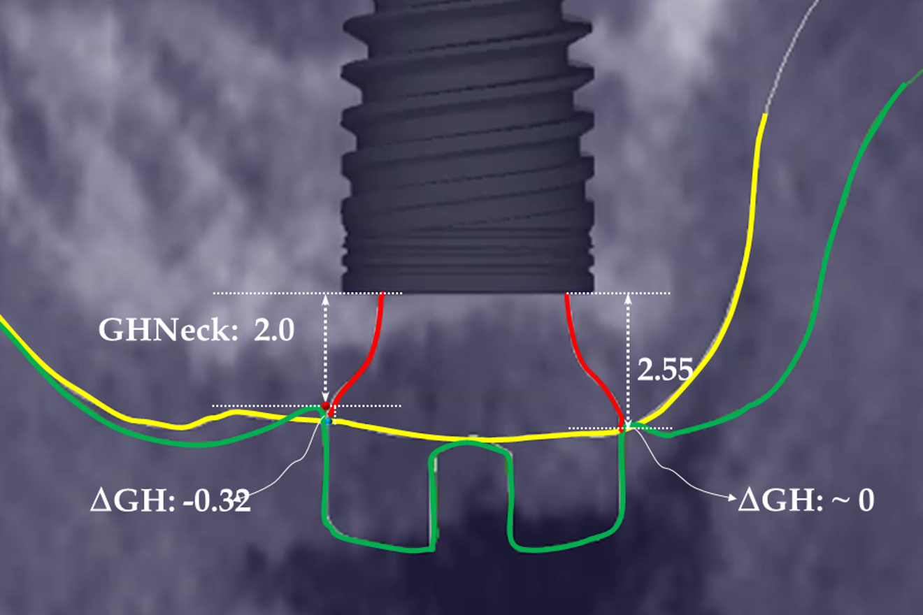 Fig. 6b: Measurement of the GH variables—change in GH (∆H) and GH at the level of the implant neck (GHNeck) on the buccal and palatal sides by the end of the soft-tissue healing. The surgical technique did not increase the GH on the buccal side, and GH on the palatal side decreased slightly. Red lines = the limits of the healing abutment.