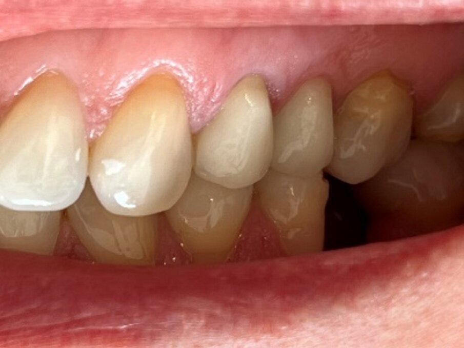 Fig: 7: Controllo dopo dieci mesi.