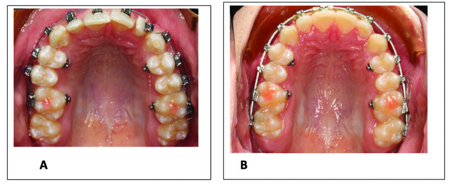 Fig. 4a. Patient R. W.’s T1 initial bonding appointment with 0.014 CN wire showing severe rotation of patient’s upper left lateral incisor. An 0.018 CN wire was placed at four weeks followed by a 0.014 x .0275 CN Ultima wire at eight weeks. Fig. 4b. T2 conclusion of the 0.014 x 0.0275 CN Ultima wire at 12 weeks, demonstrating correction of the rotation.