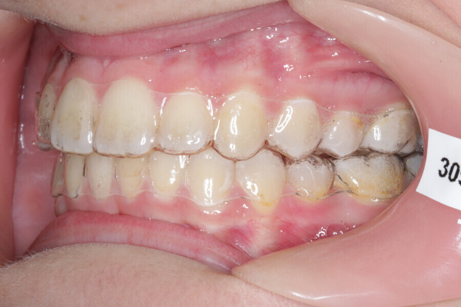 Fig. 16: Aligner #22.