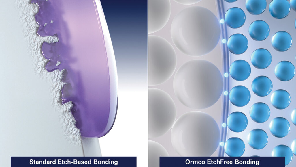 Ormco EtchFree Bonding system: Introducing the next generation of bonding, inspired by nature