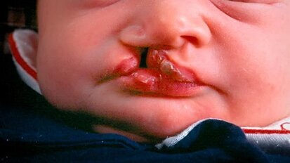 „Wir haben eine Region auf Chromosom 8 identifiziert, quasi das Haupt-Gen für Lippen-Kiefer-Gaumenspalten.“