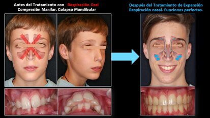 Sellado bucal y respiración oral: qué dice realmente la ciencia