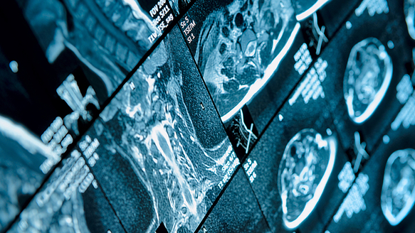 AO Orlando preview: Sinus floor bone graft