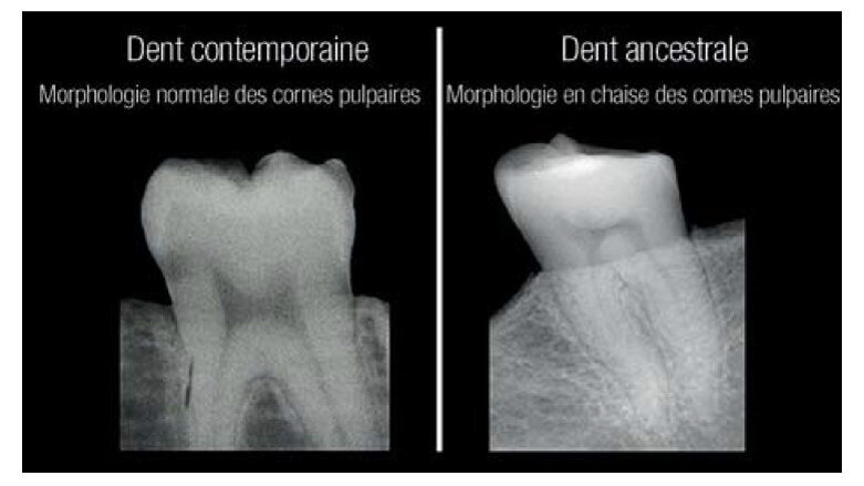 Selon une nouvelle étude, les radiographies dentaires peuvent révéler une carence en vitamine D