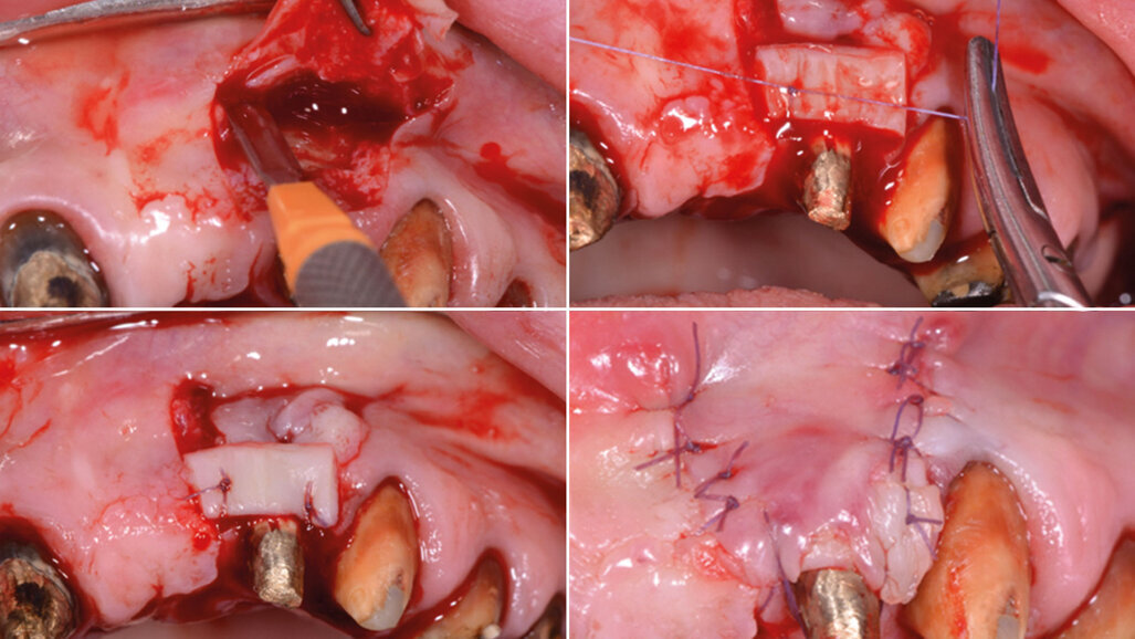 Riabilitazione totale di tipo estetico-funzionale con terapia parodontale, implantare, protesica, mucogengivale e gnatologica