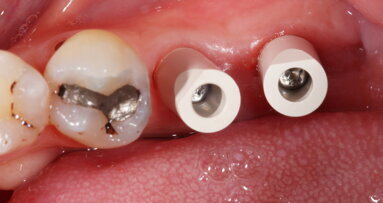 Mastering the implant digital workflow