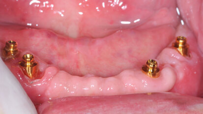 Protesi superiore e inferiore su componentistica Rhein83