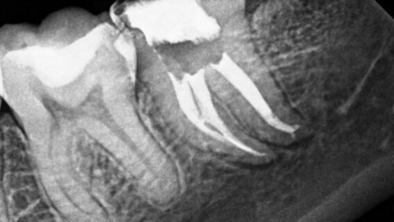 PHAST PIPS: The photoacoustic wave of the future?