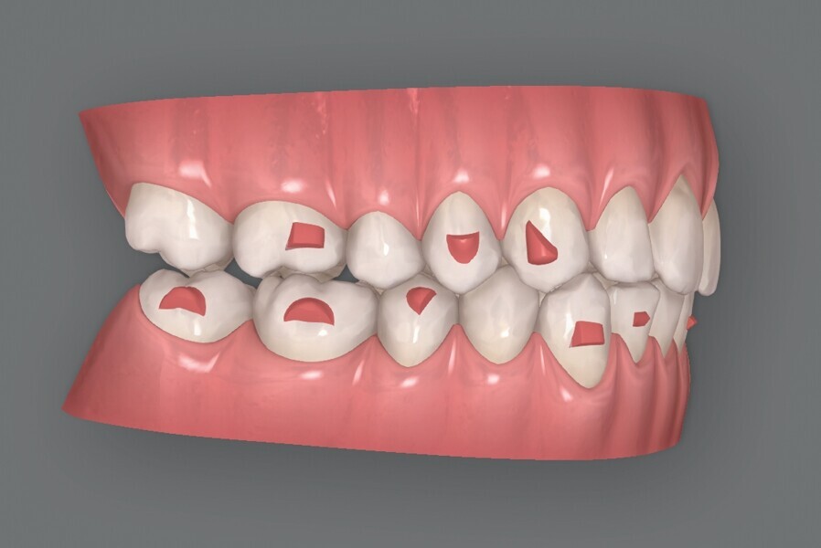 Figs. 5d : Plan supplémentaire du traitement par aligneurs conçu par ClinCheck (début). 