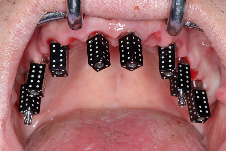 Fig. 15c: Photogrammetry scan bodies used to validate and confirm the Grammetry implant positions.