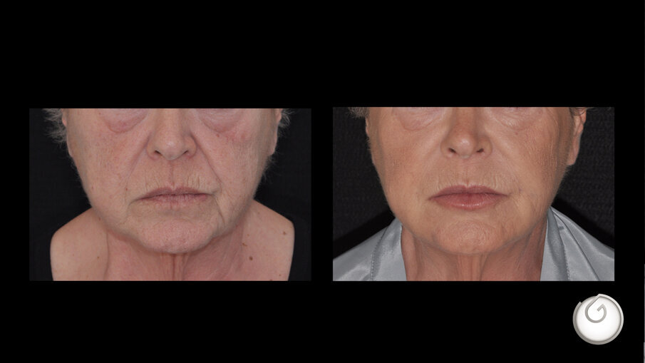 Prima e dopo il trattamento