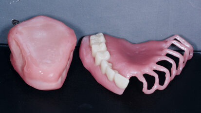 Digitálně vyrobený obturátor  s využitím virtuálních dat a 3D tisku